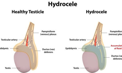 Hydrocoel