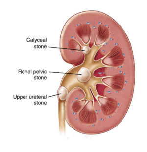 Kidney-Stones