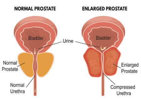 Prostate